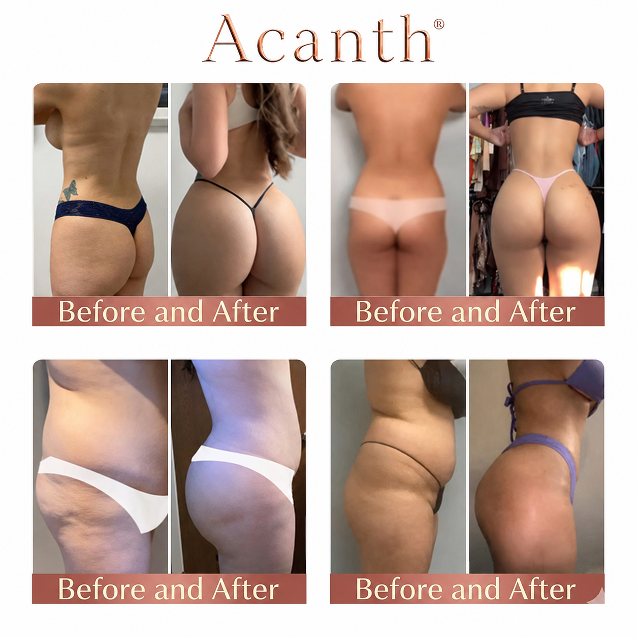 Acanth® CurveSculpt Micro-Patch ✦ Sculpt • Firm • Smooth Lower Body Curves ✦ Micro-Needle Infusion System