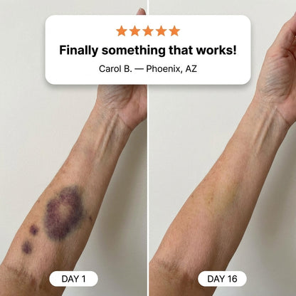 💥LAST DAY SALE 50%OFF💕- Acanth® Bruise Repair & Skin-Strengthening Cream